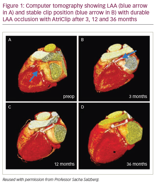Figure 1: Computer tomography showing LAA (blue arrow in A) and stable clip position (blue arrow in B) with durable LAA occlusion with AtriClip after 3, 12 and 36 months