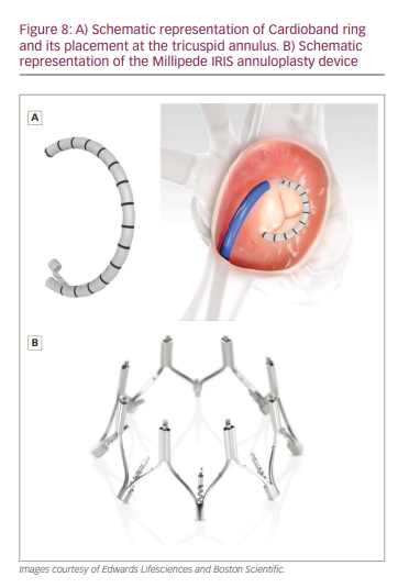 A virtual sizing tool for mitral valve annuloplasty - Rausch - 2017 -  International Journal for Numerical Methods in Biomedical Engineering -  Wiley Online Library