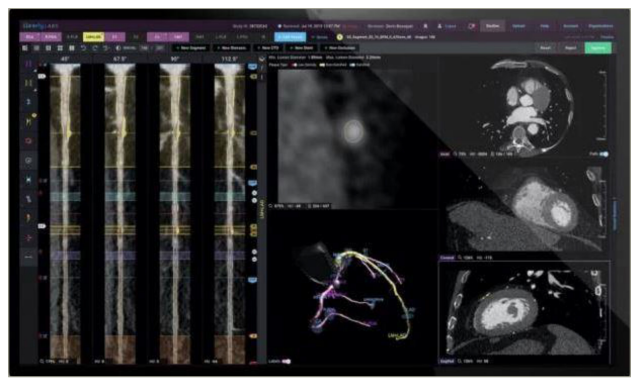 Figure 1: Quantitative plaque analysis from coronary computed tomography angiography utilizing specialized software